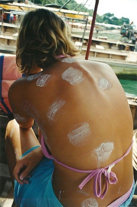 Mosquito bites on  woman's back Koh Phi Phi